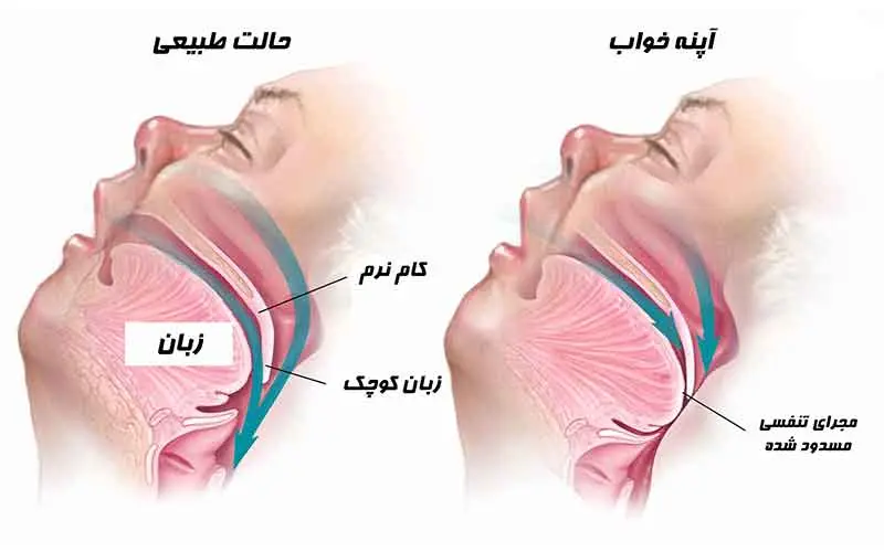 احتمال سکته قلبی با آپنه خواب افزایش می یابد | راه حل و درمان آپنه خواب + مطالعات آپنه خواب