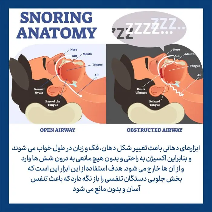 احتمال سکته قلبی با آپنه خواب افزایش می یابد | راه حل و درمان آپنه خواب + مطالعات آپنه خواب