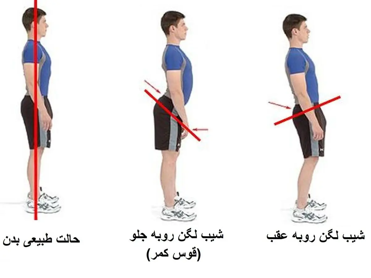 گودی کمر را به صورت تخصصی تر مورد بررسی قرار بدهید و بعد به پزشک مراجعه کنید!!! گودی کمر را به صورت تخصصی تر مورد بررسی قرار بدهید و بعد به پزشک مراجعه کنید!!!