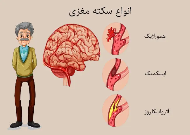با این کار به درمان خانگی سکته مغزی بپردازید | برای درمان سکته مغزی کدام اقدام بهتر است انجام شود؟ درمان خانگی