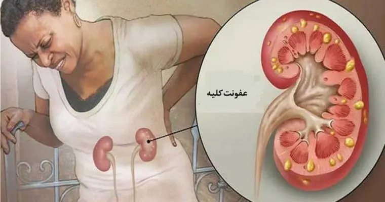 درمان خانگی با گیاهان دارویی عفونت کلیه | درمان عفونت کلیه از روش طب سنتی شرقی با چای! کلیه
