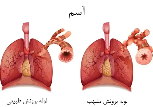 این بیماری این روزها بسیار رایج شده است!! | بیش از 300 میلیون نفر در جهان در گیر آسم اند آسم