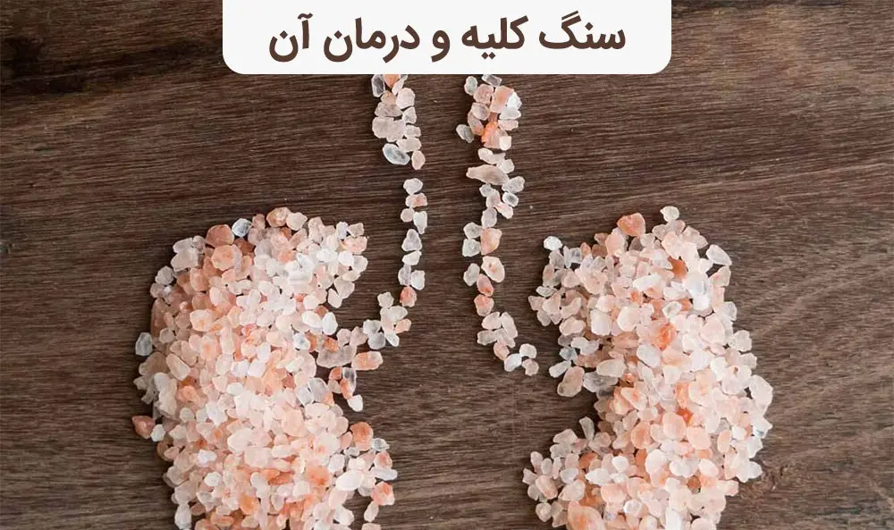 چه کنیم تا سنگ کلیه نگیریم؟ | درمان سنگ کلیه سنگ کلیه