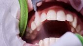 جرم‌گیری، راهی موثر برای پیشگیری از پوسیدگی و بیماری لثه