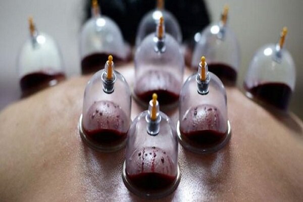 حجامت توسط افراد غیر متخصص خطرناک است حجامت توسط افراد غیر متخصص خطرناک است