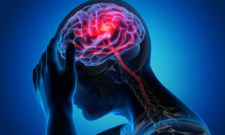 تحریک نخاع به بازیابی قدرت بازو پس از سکته مغزی کمک می کند تحریک نخاع به بازیابی قدرت بازو پس از سکته مغزی کمک می کند